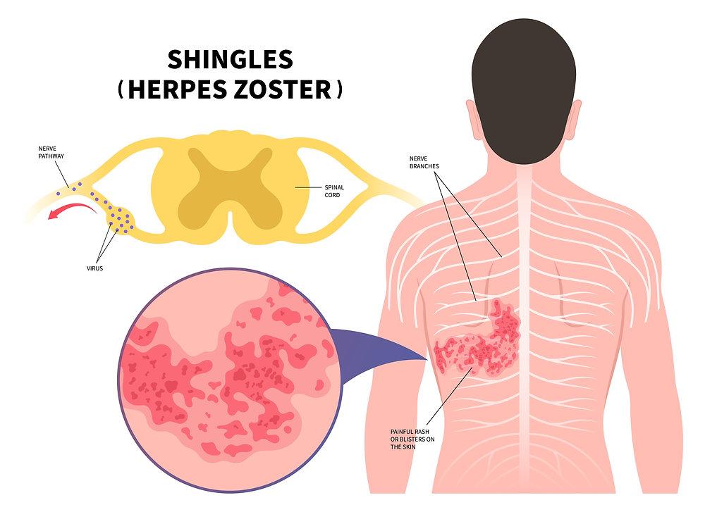 Vacina contra herpes-zóster pode entrar no calendário do SUS; veja quem poderá receber